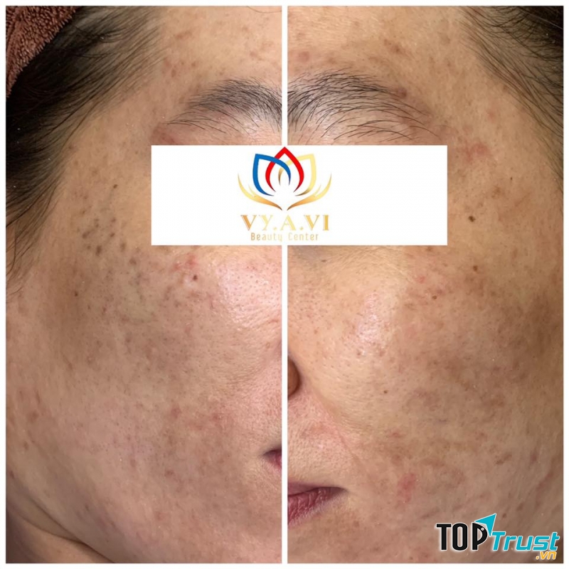 VY.A.VI Spa Bạc Liêu