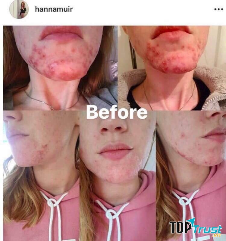 Xà phòng trị mụn Charcoal & Tea Tree Oil