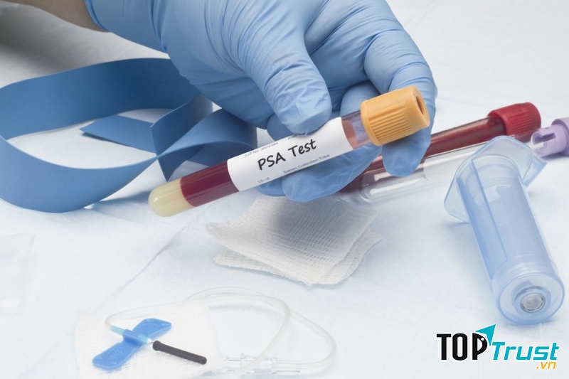 Xét nghiệm sàng lọc kháng nguyên tuyến tiền liệt
