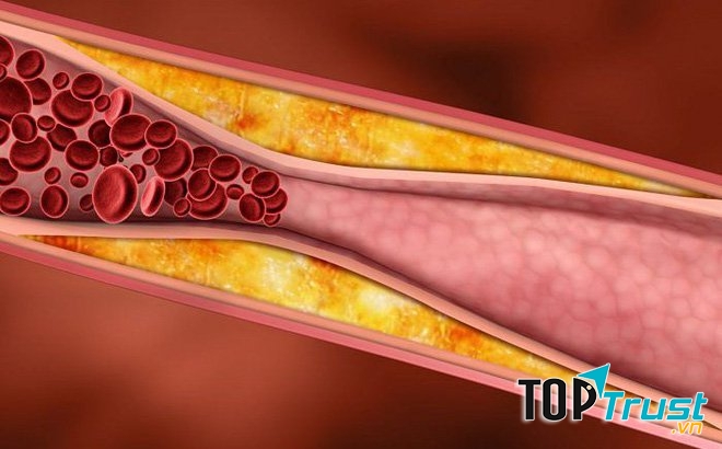 Mảng xơ vữa gây hẹp lòng mạch, cản trở dòng máu lưu thông