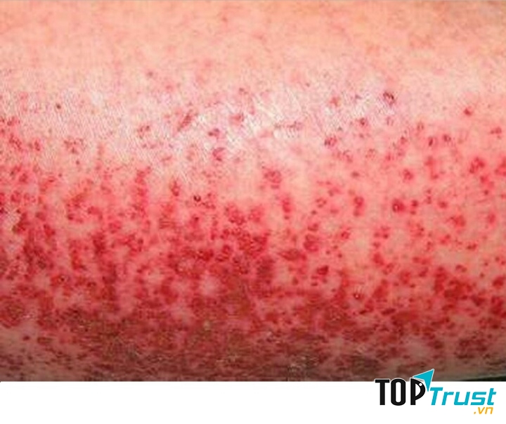 Những thay đổi bất thường trên da của người mắc viêm gan B