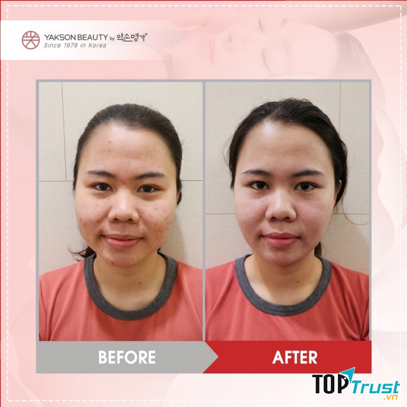 Sau khi được trị liệu chăm sóc da bằng liệu pháp Golki tại Yakson