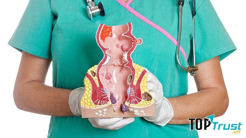 Bài thuốc dân gian chữa bệnh trĩ tại nhà bạn nên biết