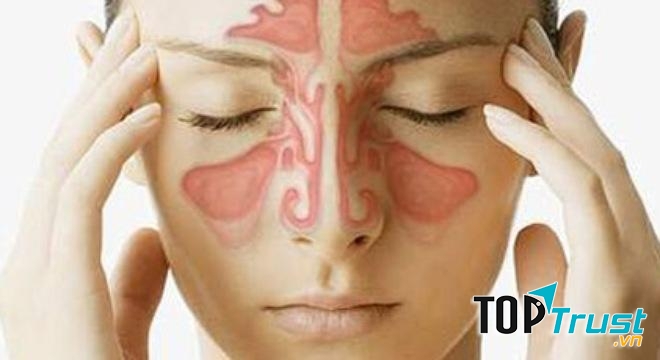 Bài thuốc dân gian chữa bệnh viêm xoang hiệu quả nhất bạn nên biết