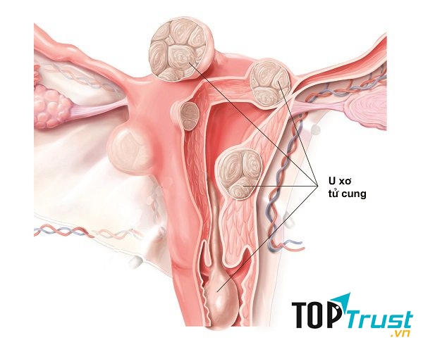 Bài thuốc dân gian chữa u xơ tử cung hiệu quả nhất tại nhà