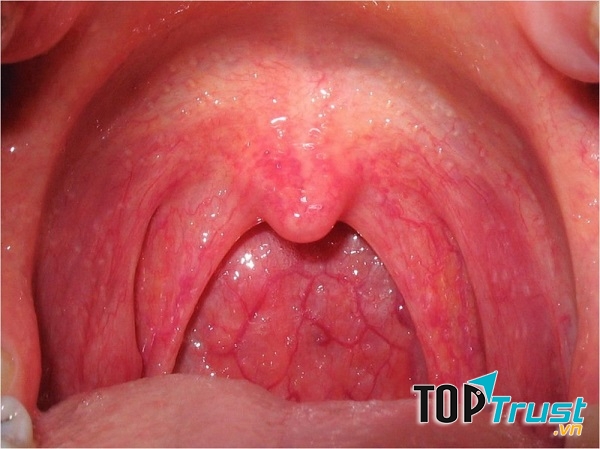 Bài thuốc dân gian chữa viêm họng hiệu quả nhất