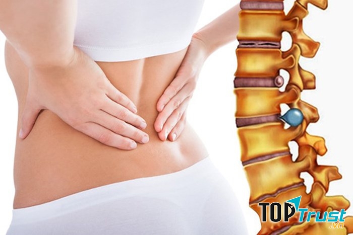 Bài thuốc dân gian hiệu quả nhất chữa thoát vị đĩa đệm tại nhà