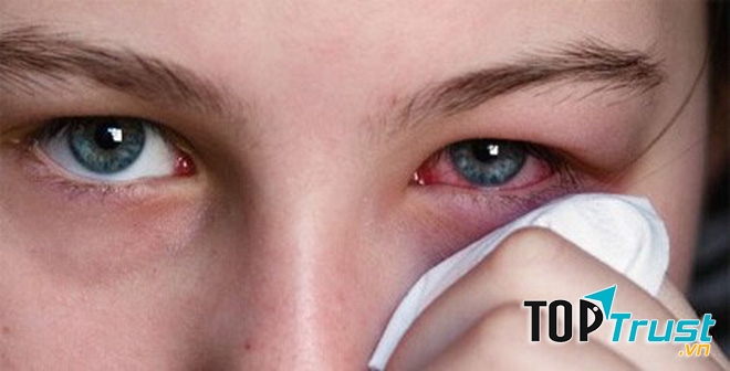 Bài thuốc dân gian hiệu quả nhất trị đau mắt đỏ