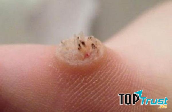 Bài thuốc dân gian tốt nhất xoá mụn cóc hiệu quả