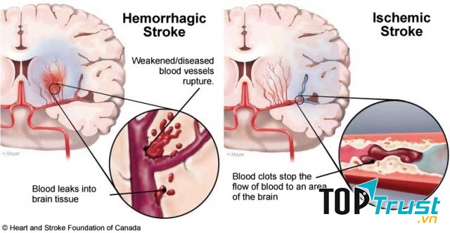 Bệnh thường gặp ở người cao tuổi và cách phòng tránh