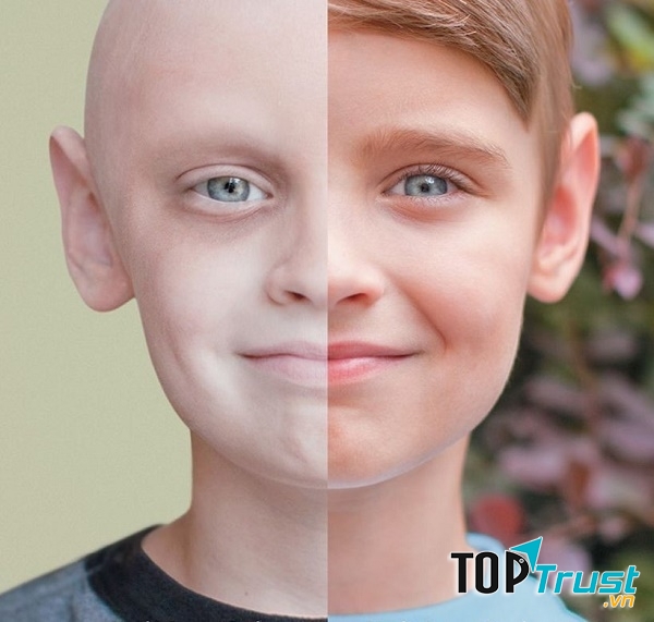 Bệnh ung thư phổ biến nhất hiện nay bạn nên biết