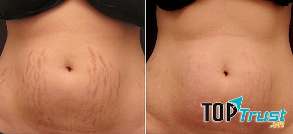 Bí quyết trị rạn da hiệu quả từ thiên nhiên