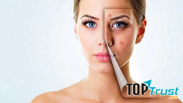 Bí quyết trị vết thâm mụn hiệu quả nhất từ thiên nhiên