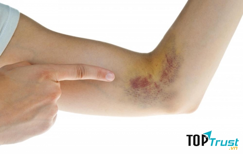 Biện pháp trị vết bầm tím hiệu quả