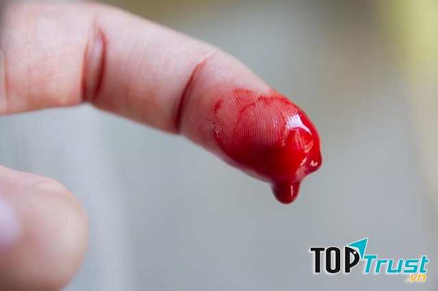 Cách cầm máu tại nhà với vết thương nhẹ hiệu quả nhất
