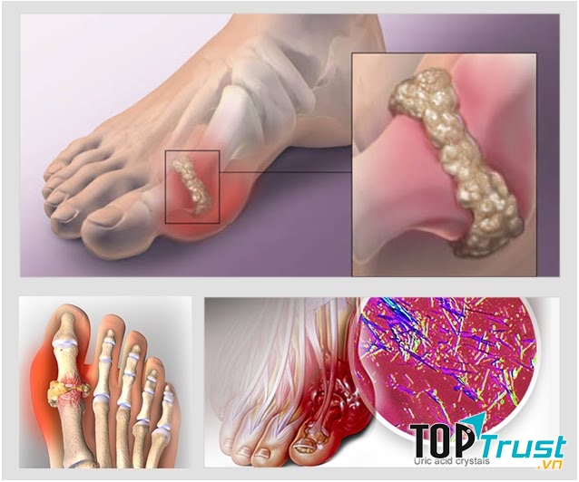 Cách chữa bệnh gout tại nhà hiệu quả nhất nên biết