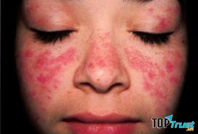 Cách chữa bệnh hắc lào tận gốc hiệu quả nhất