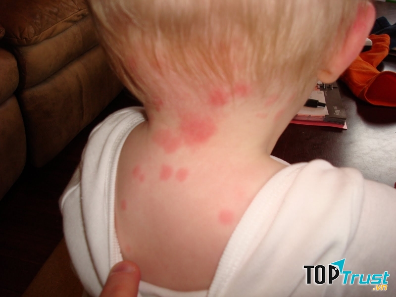 Cách chữa bệnh hiệu quả khi bị bọ đỏ cắn