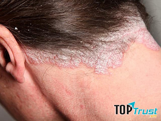 Cách chữa bệnh vẩy nến hiệu quả nhất không cần dùng thuốc