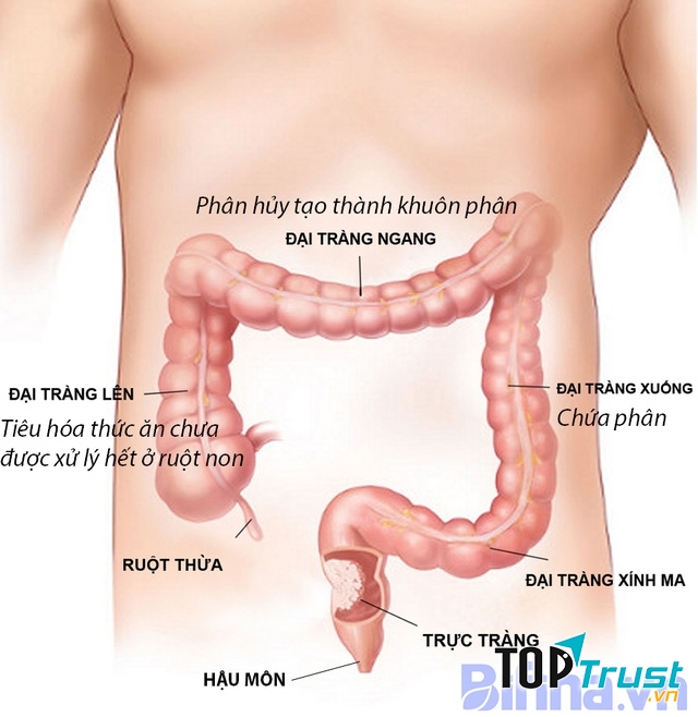 Cách chữa bệnh viêm đại tràng theo dân gian hay nhất