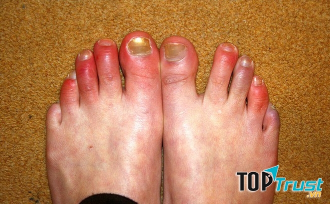 Cách chữa cước chân nhanh nhất