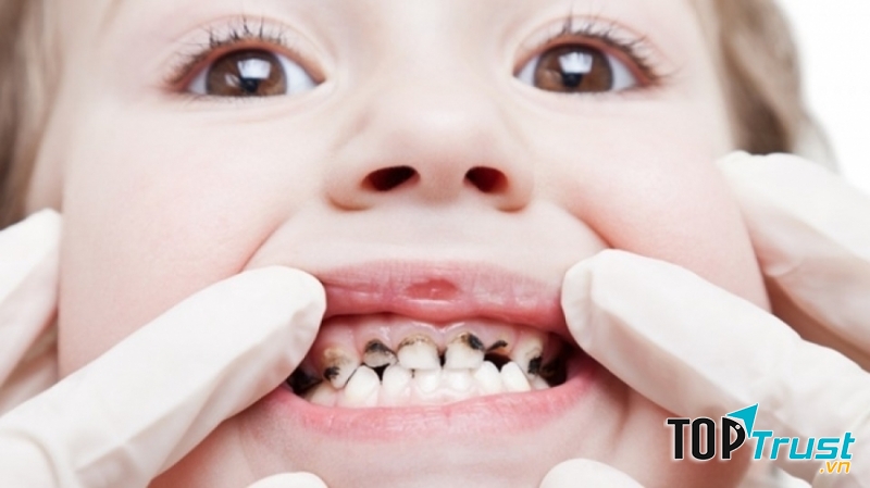 Cách chữa sâu răng đơn giản và triệt để nhất