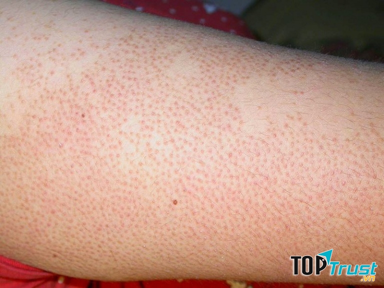 Cách chữa viêm lỗ chân lông ở chân đơn giản tại nhà