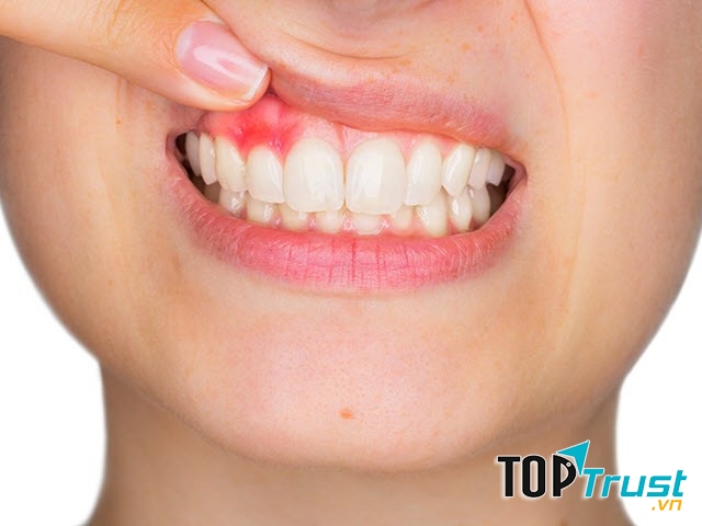 Cách chữa viêm lợi hiệu quả nhất tại nhà