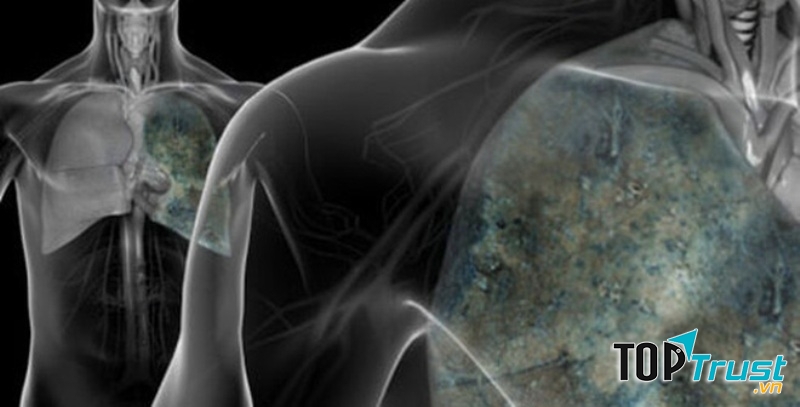 Cách đơn giản phòng ngừa bệnh ung thư phổi