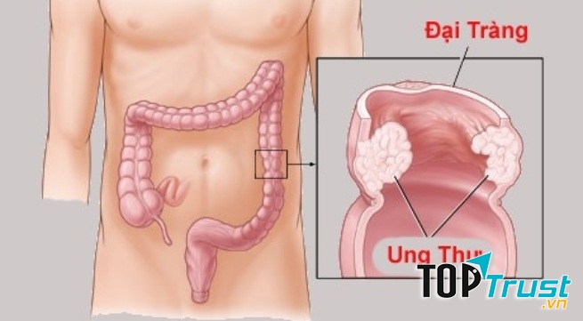 Cách làm giảm nguy cơ ung thư đại tràng bạn cần phải biết