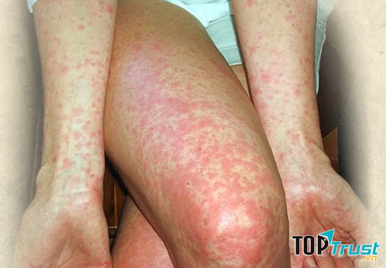 Cách trị bệnh mề đay hiệu quả nhất tại nhà
