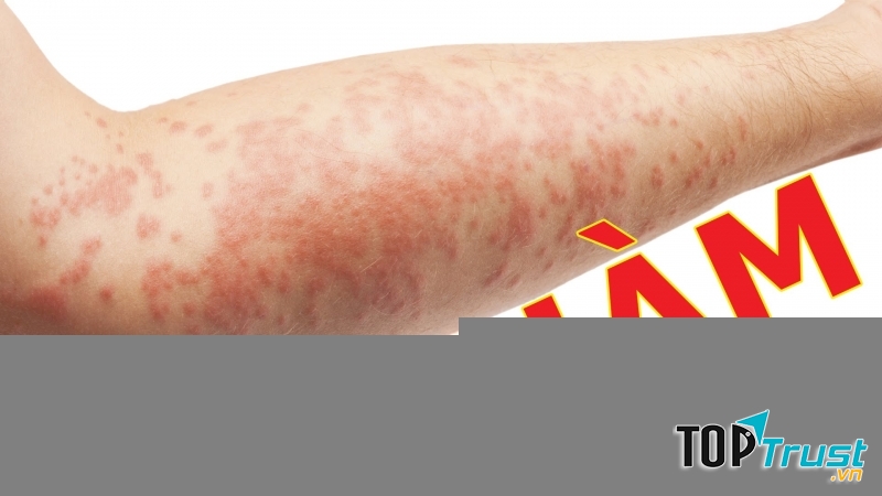 Cách trị chàm hiệu quả nhất từ nguyên liệu thiên nhiên