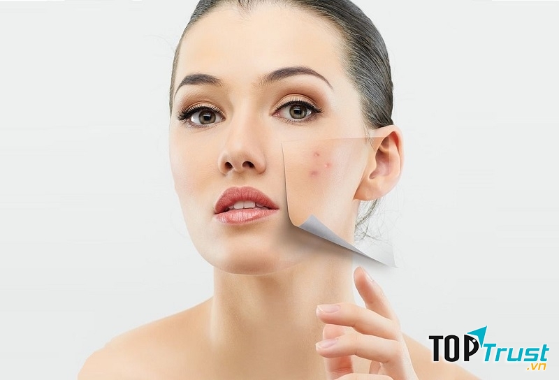 Cách trị mụn đơn giản mà hiệu quả bất ngờ nhất