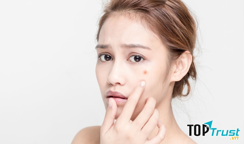 Cách trị mụn mùa hè hiệu quả nhất bạn nên áp dụng