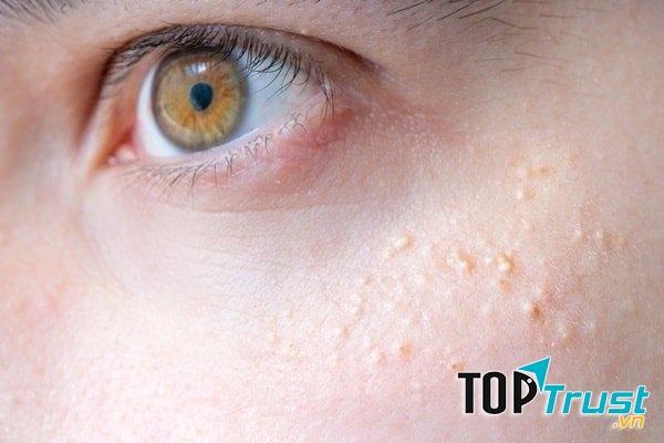 Cách trị mụn thịt tại nhà hiệu quả và an toàn nhất