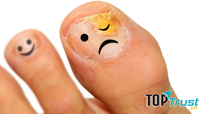 Cách trị nấm móng tay chân hiệu quả nhất từ dân gian