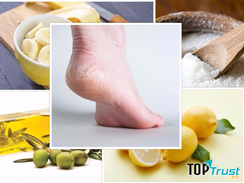 Cách trị nứt nẻ ở gót chân tự nhiên và an toàn nhất