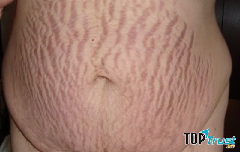 Cách trị rạn da sau sinh hiệu quả tại nhà