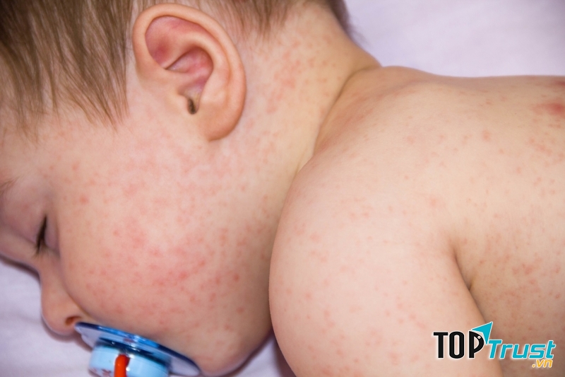 Cách trị rôm sảy mùa hè cho bé