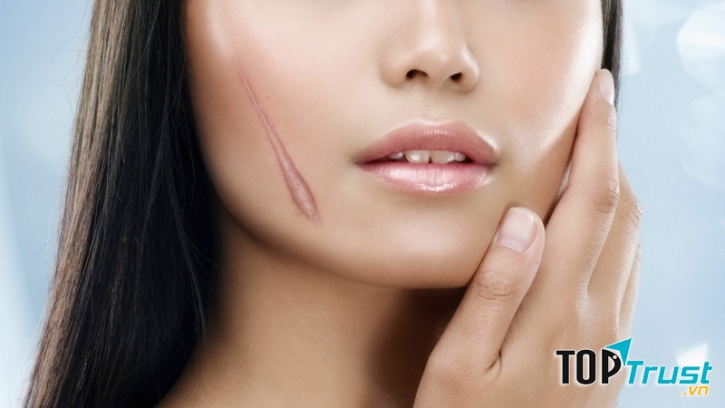 Cách trị sẹo hiệu quả nhất bằng phương pháp tự nhiên