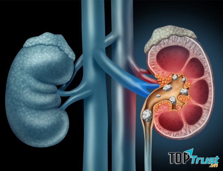 Cách trị sỏi thận tại nhà không cần dùng thuốc