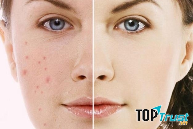 Cách trị thâm mụn hiệu quả tại nhà nhanh nhất