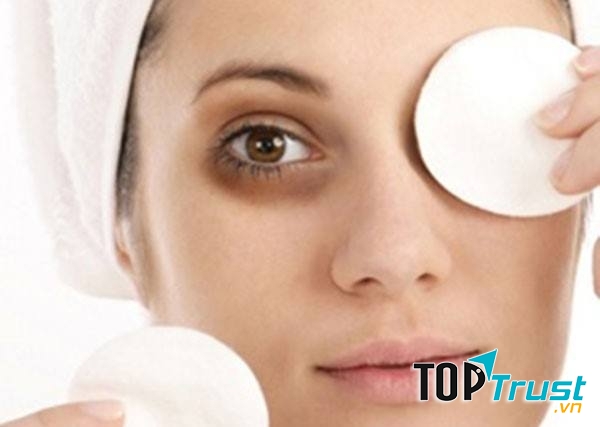 Cách trị thâm quầng mắt đơn giản, hiệu quả và tiết kiệm