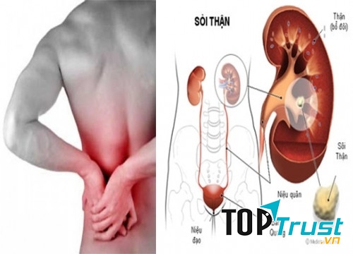 Công thức thần kì đánh bay sỏi thận không lo tái phát