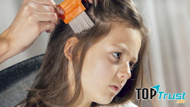 Dầu gội trị chấy hiệu quả, an toàn nhất hiện nay