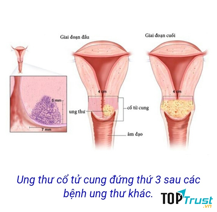 Dấu hiệu của bệnh ung thư cổ tử cung ở phụ nữ