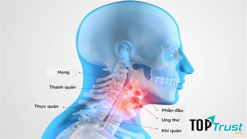 Dấu hiệu của ung thư vòm họng giai đoạn đầu