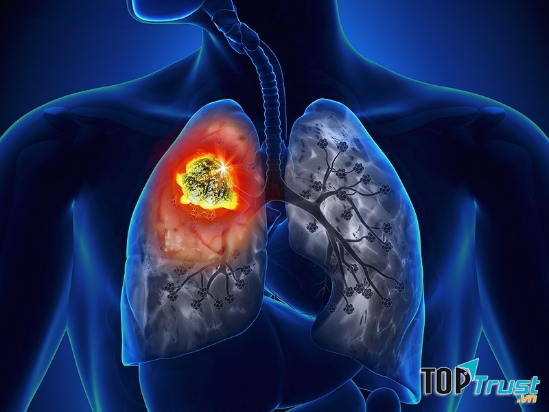Dấu hiệu nhận biết ung thư phổi giai đoạn đầu
