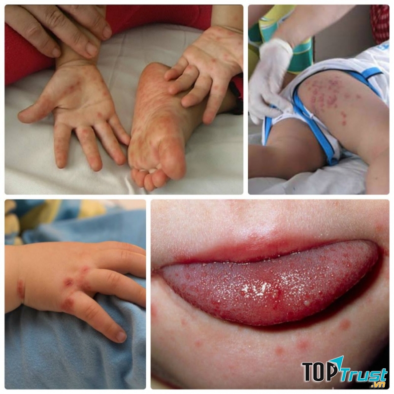 Dấu hiệu tay chân miệng ở trẻ bố mẹ đừng bỏ qua