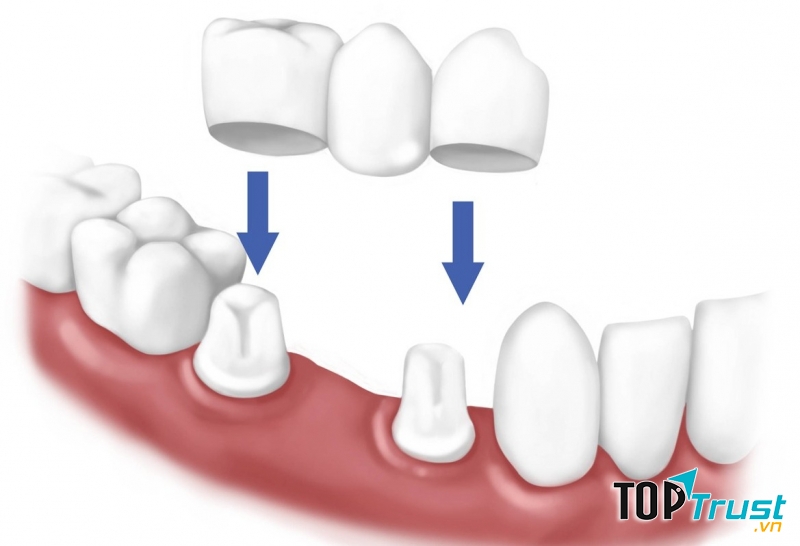 Địa chỉ bọc răng sứ thẩm mỹ tốt nhất tại quận 1, TP HCM